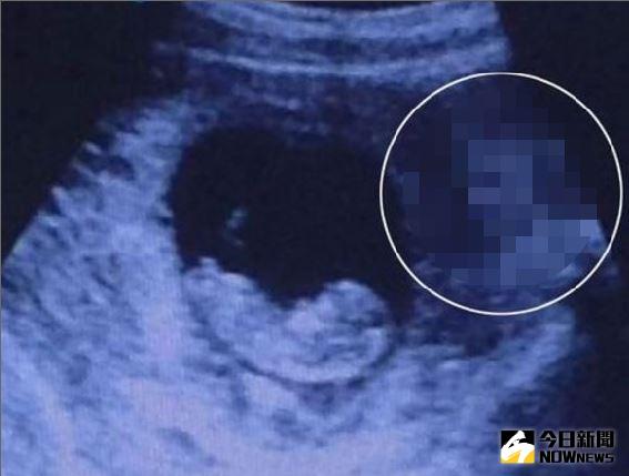▲國外網友在reddit論壇上傳一張超音波胎兒照，藏匿在腹中的謎樣物究竟是魔鬼還是善靈？無從而知。（圖／翻攝自《鏡報》）