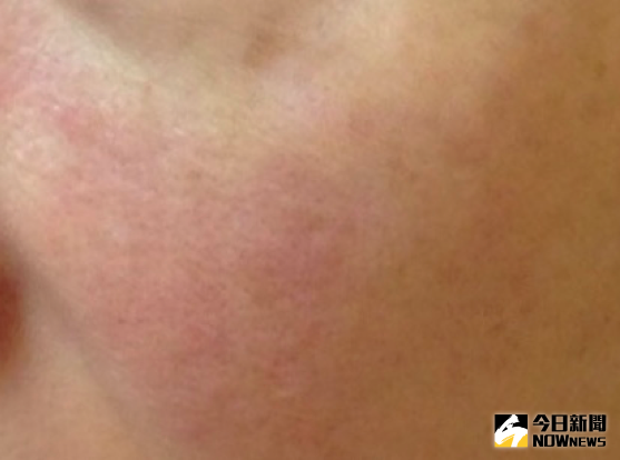 ▲女子抹類固醇藥膏成癮，一停藥皮膚就刺痛、灼熱到好似被開水燙過。（圖／徐嘉琪提供）