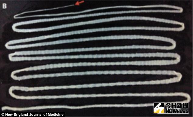 ▲大陸38歲男子愛吃生牛肉，卻因此拉出6.2公尺牛帶絛蟲。（圖／翻攝自dailymail）