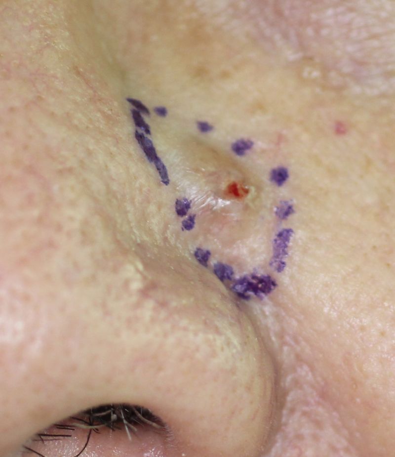 ▲男子一直以為鼻子的凸起物是青春痘，但十多年不曾消退，就醫才知是皮膚癌。（圖／書田診所提供）