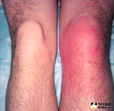 ▲敗血性關節炎常被誤認為痛風發作而輕忽，但除了同樣紅腫熱痛之外，敗血性關節炎還會合併高燒。（圖／蔡明翰提供）