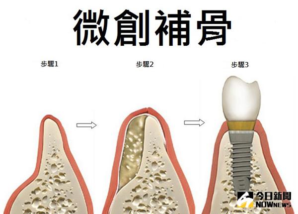 ▲黃奇卿醫師指出，缺牙的患者可透過微創補骨搭配微創植牙，強化假牙地基。（圖／公關照片）