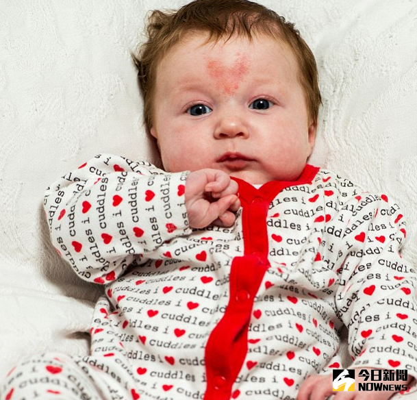 ▲英國小女嬰波比，一出生額頭就有心型胎記。（圖／翻攝自dailymail）