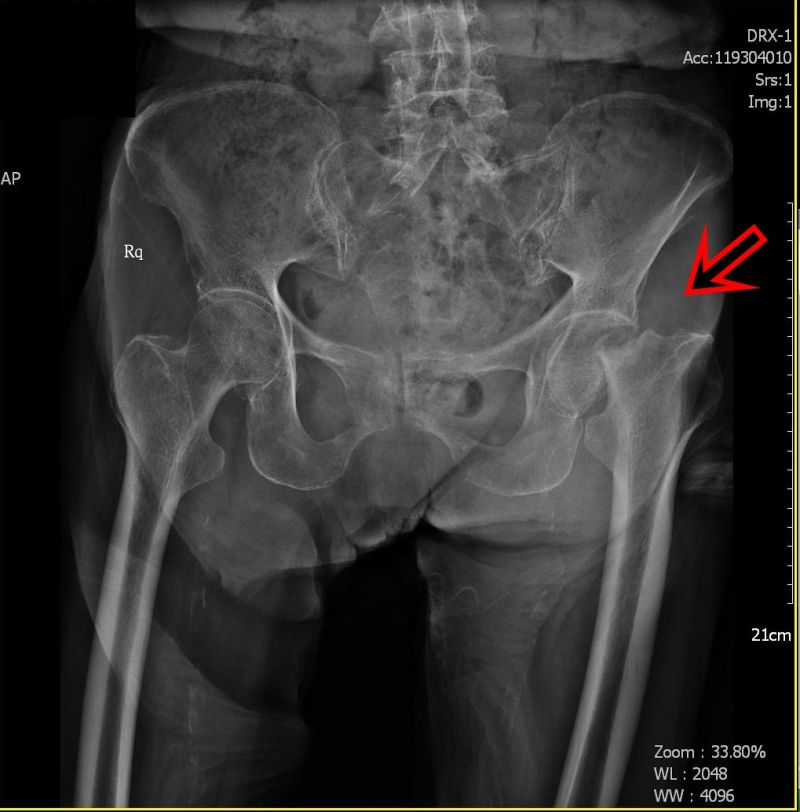 ▲老年人股骨頸骨質疏鬆脆弱，醫師提醒，就算是不大的外力衝擊都可能骨折。（圖／童綜合醫院提供）