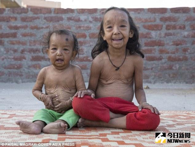 ▲印度姐弟患有早衰症，皮膚充滿皺紋。（圖／翻攝自dailymail）
