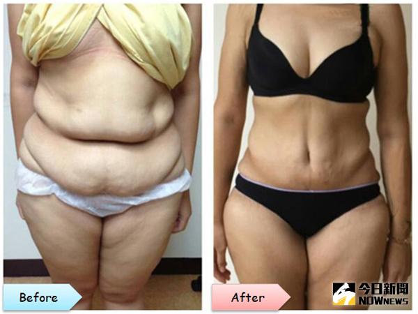 ▲腹部全層脂雕及腹部拉皮筋膜緊實手術前後比較。（圖／詹富盛醫師提供）