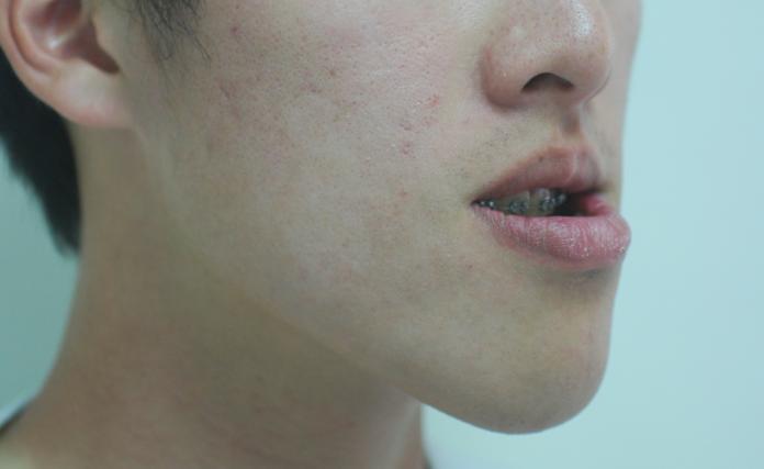 ▲天生戽斗常叫不少人備感自卑，醫師臨床經驗發現，有3成戽斗男女會留長髮、蓄鬍鬚擋下巴。（圖非新聞當事人）