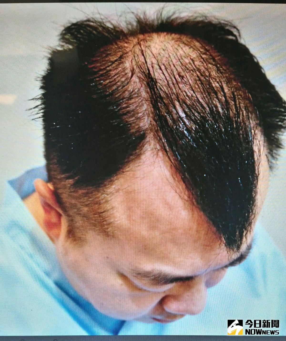 ▲藝人董至成遺傳父親的雄性禿，加上壓力、造型需求禿頭，靠植髮找回自信。（圖／楊名權提供）