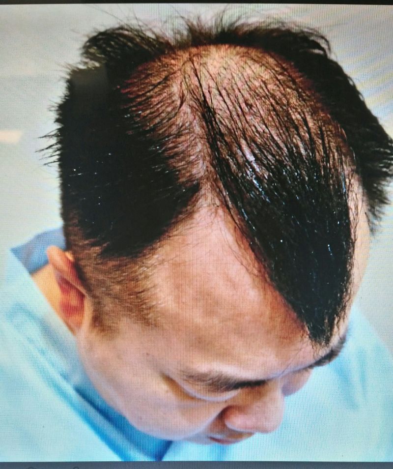 ▲藝人董至成遺傳父親的雄性禿，加上壓力、造型需求禿頭，靠植髮找回自信。（圖／楊名權提供）