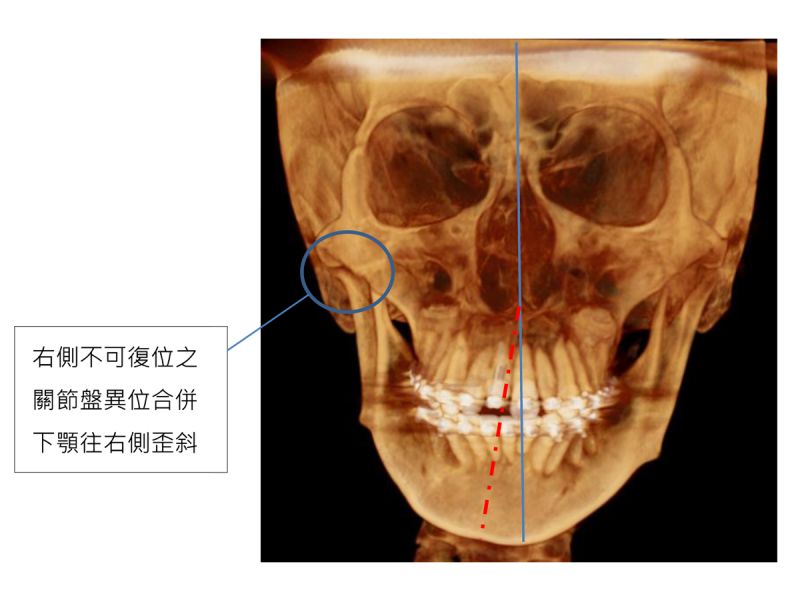 ▲造成青少年顏面歪斜　不可忽略的「隱形殺手」