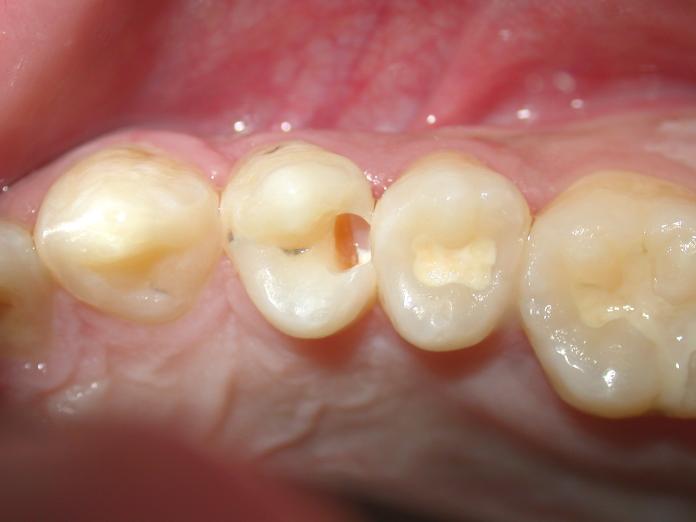 ▲牙醫師提醒，冬天習慣用溫水刷牙，可能讓蛀牙等口腔問題不易被察覺。（圖／黃耀慧提供）