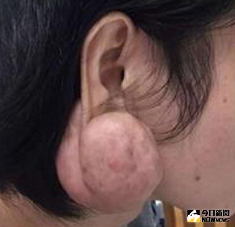 ▲強國男打耳洞，耳垂腫成「撞球」。（圖／翻攝自網路）