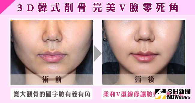 ▲李準馥醫師表示，韓國人的骨骼大，所以調整臉部削骨的幅度較大，而台灣人通常只需微調曲線。（圖／公關照片）