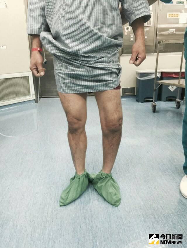 ▲男子再次手術前左腳歪斜，左右腿長短不一。（圖／童綜合醫院提供）