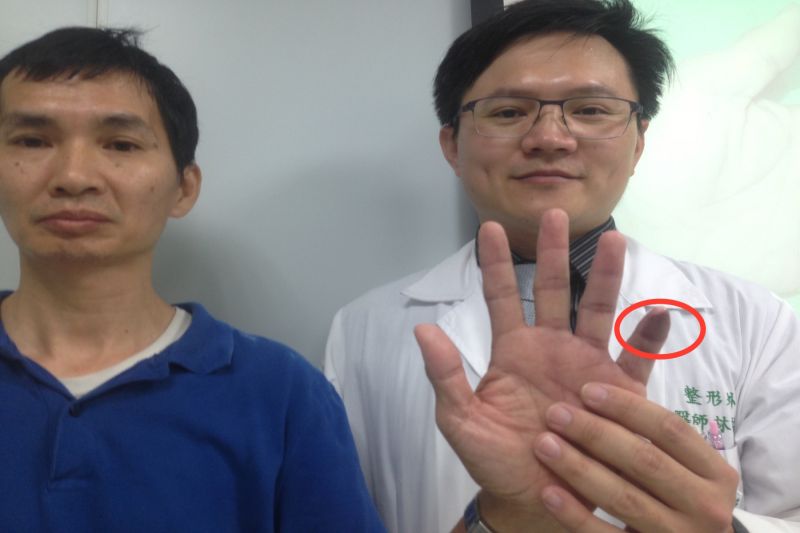 ▲陳某遭機械撕裂左小指整塊指腹組織(圈紅處)經整形外科醫師林祐丞手術治療恢復正常功能。（圖／黃芳祿攝）