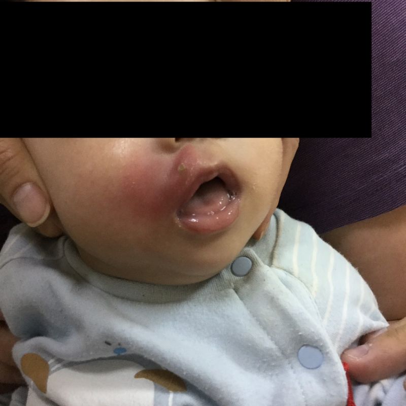 ▲天熱蚊子肆虐，小嬰兒遭咬竟變蜂窩性組織炎。（圖／童綜合醫院提供）