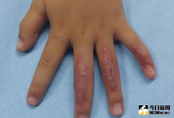 ▲男童小手遭跑步機捲入磨傷，採用人工真皮輔助高壓氧治療一個多月，傷口才癒合。〈圖／記者黃玿琮翻攝〉。（圖／翻攝自網路）