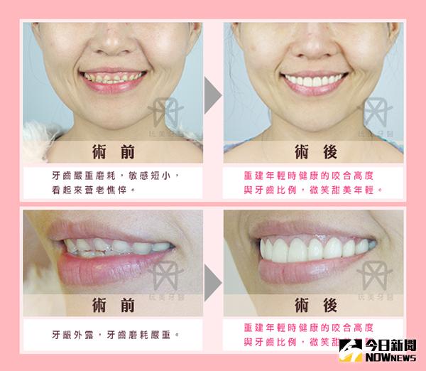 ▲常喝市售酸性飲料可能會造成牙齒大崩壞。（圖／公關照片）