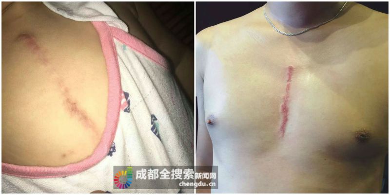 兒子身上的疤痕（左），父親文身後的疤痕（右）。