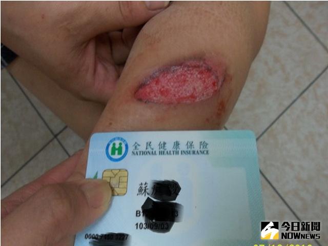 ▲騎士被機車燙傷。（圖／林重鎣攝）