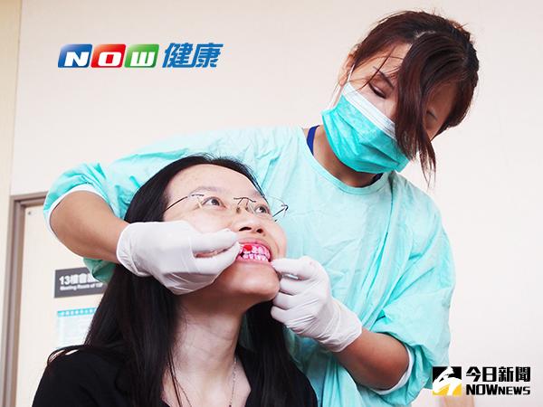 ▲塗上牙菌斑顯影劑後滿嘴鮮紅，可見口腔中菌斑與細菌很多。（圖／公關照片）