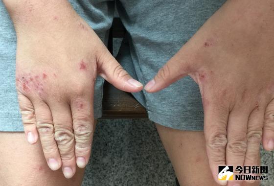 ▲孫小弟的頭臉耳後、軀幹、四肢皮膚都有紅斑性丘疹，疑是家中養貓可能是異位性皮膚炎反覆發作與惡化的誘因之一。〈圖／台中慈濟醫院提供〉