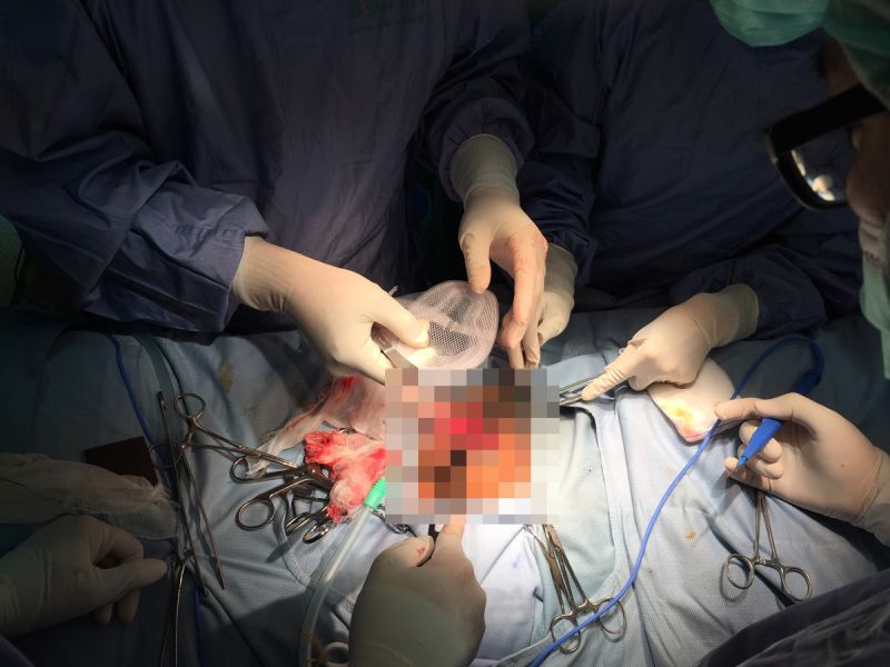 ▲疝氣治療，人工網膜助降低復發。