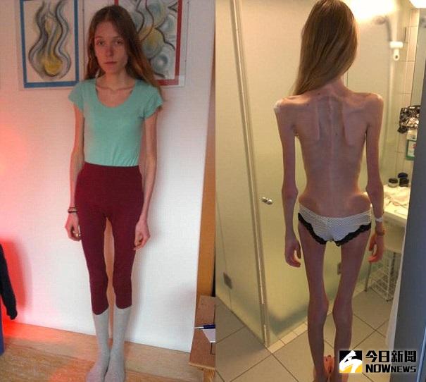 ▲漢娜曾罹患厭食症，體重只剩下30公斤。（圖／翻攝自dailymail）