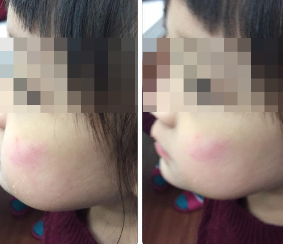 ▲▲新竹市一名3歲女童因糖果分配問題被同班男童毆打，由於類似事件一年來已發生三起，家長決定提告傷害。（圖／翻攝自爆料公社）