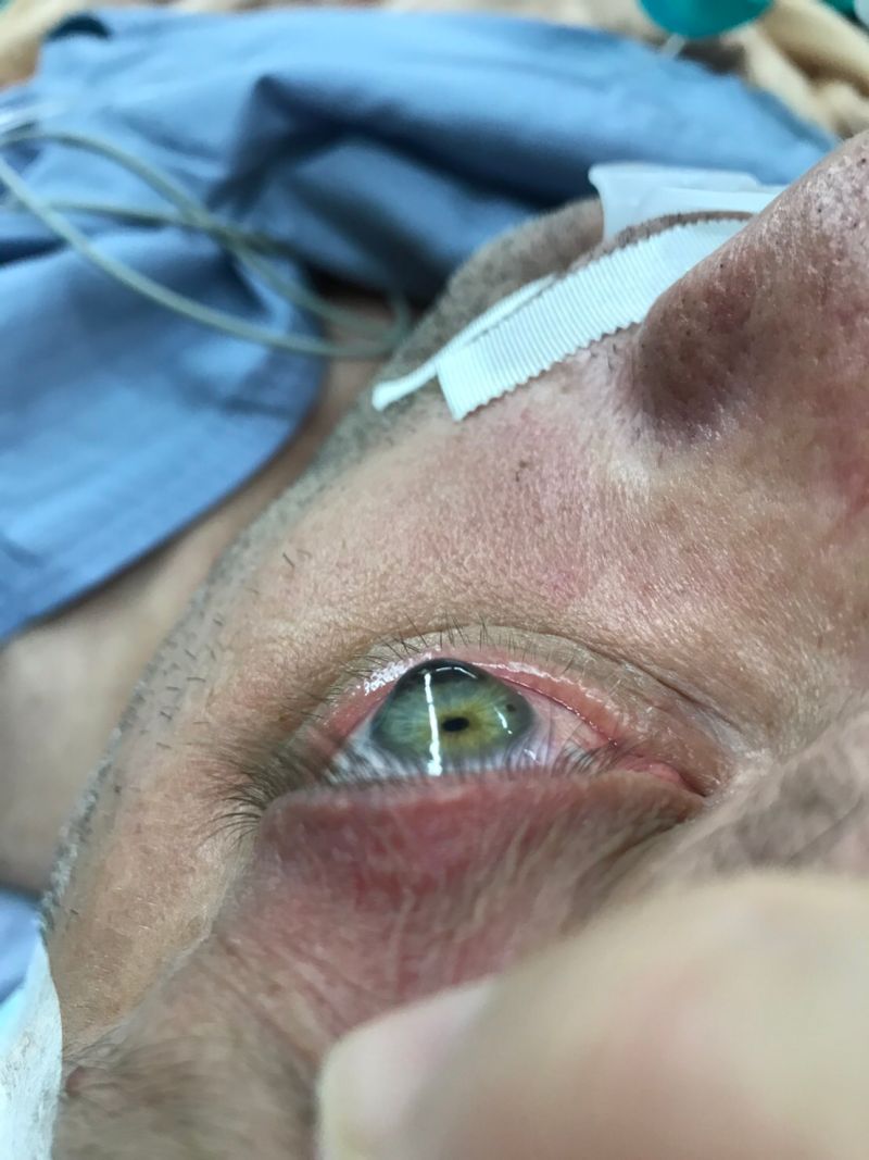 ▲男子手術前眼角膜呈現圓錐狀。（圖／台北慈濟醫院提供）