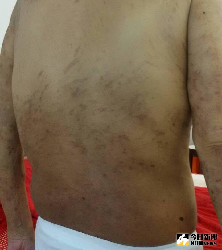 ▲治療後，背部搔癢狀況才漸恢復。（圖／台北慈濟醫院提供）