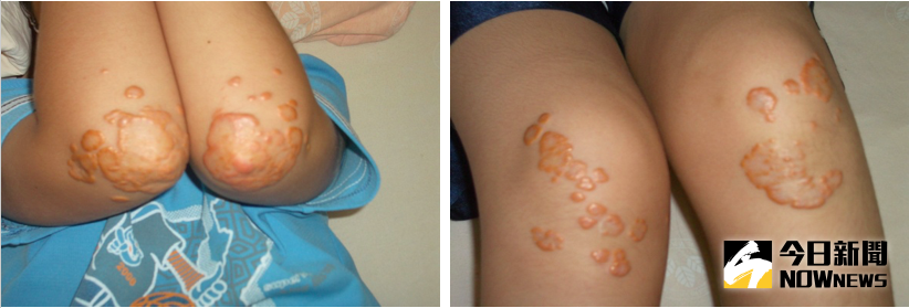 ▲家族性高膽固醇血症患者常在手肘、膝蓋與腳跟出現黃色的脂肪瘤。（圖／常敏之醫師提供）