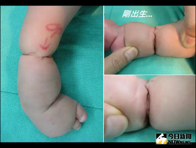 ▲先天限制環症候群病童又被稱為「米其林寶寶」，因為身上有圈狀皺褶。（圖／台北榮總提供）