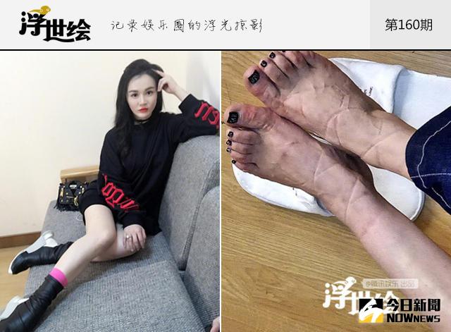 近日，鄒市明妻子冉瑩穎曬出一張自己腳部的照片，因為鞋子的問題，她的腳趾被勒得發紅，更留下了一些勒痕。