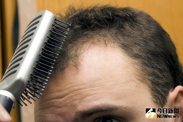 ▲中醫師指出，脂漏性皮膚炎病人的皮屑油膩，在頭皮易滋生細菌。（圖／ingimage）