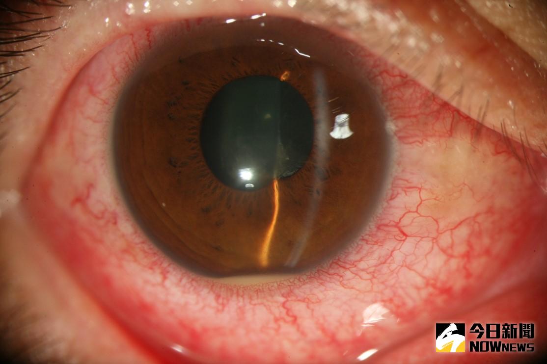 ▲僵直性脊椎炎患者常併發虹彩炎。（圖／資料來源：黃奕修醫師）