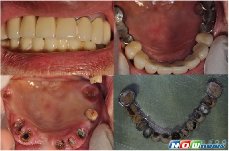 ▲糖尿病患者容易併發牙周病，醫師提醒重視口腔保健。（圖／東元醫院提供，2017.5.9）