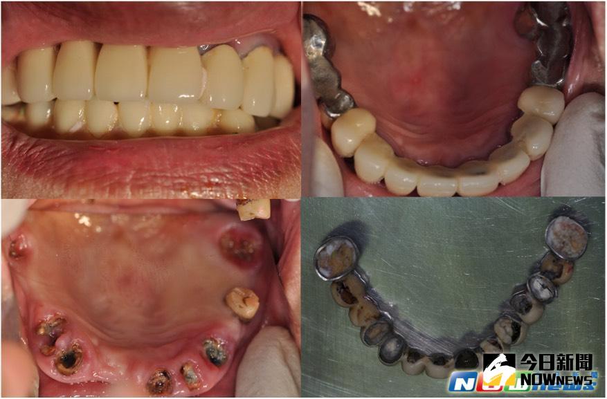 ▲糖尿病患者容易併發牙周病，醫師提醒重視口腔保健。（圖／東元醫院提供，2017.5.9）