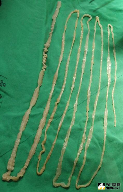 ▲國小女童吃生魚片染絛蟲，取出長達2.6公尺的活蟲。（圖／三軍總醫院提供）