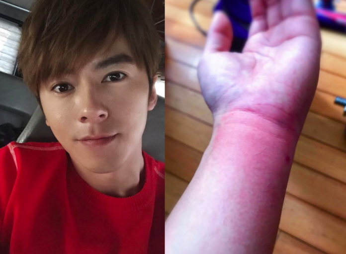 ▲李國毅被蜜蜂螫，貼心的他不想在颱風過後假日就診，給醫院急診添麻煩。（合成圖／翻攝自李國毅Instagram，2017.07.30）
