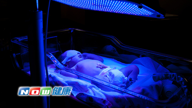 成大醫院小兒部陳東華醫師表示，極度早產兒的黃疸處理需特別小心，若屬於「病理性黃疸」，得在確認病情後進行黃疸換血治療，以避免是膽道閉鎖導致的風險。（圖／ingimage）