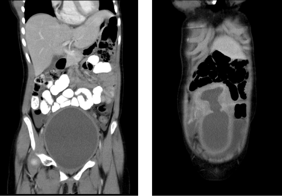 ▲罕見處女膜閉鎖合併陰道橫膈。（圖／三軍總醫院提供）