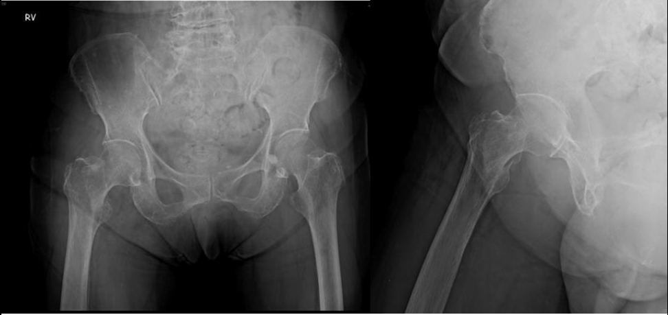 ▲老年人常見的骨質疏鬆，讓老年人骨折風險顯著增加。（圖／北市聯醫提供）