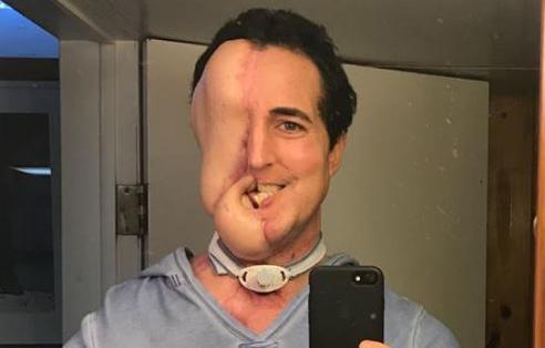 美國密西根州的一名38歲男子麥格拉斯因臉部罹患罕見癌症「滑膜肉瘤」，導致半邊臉長出巨大腫瘤。（圖／翻攝自獨立報）