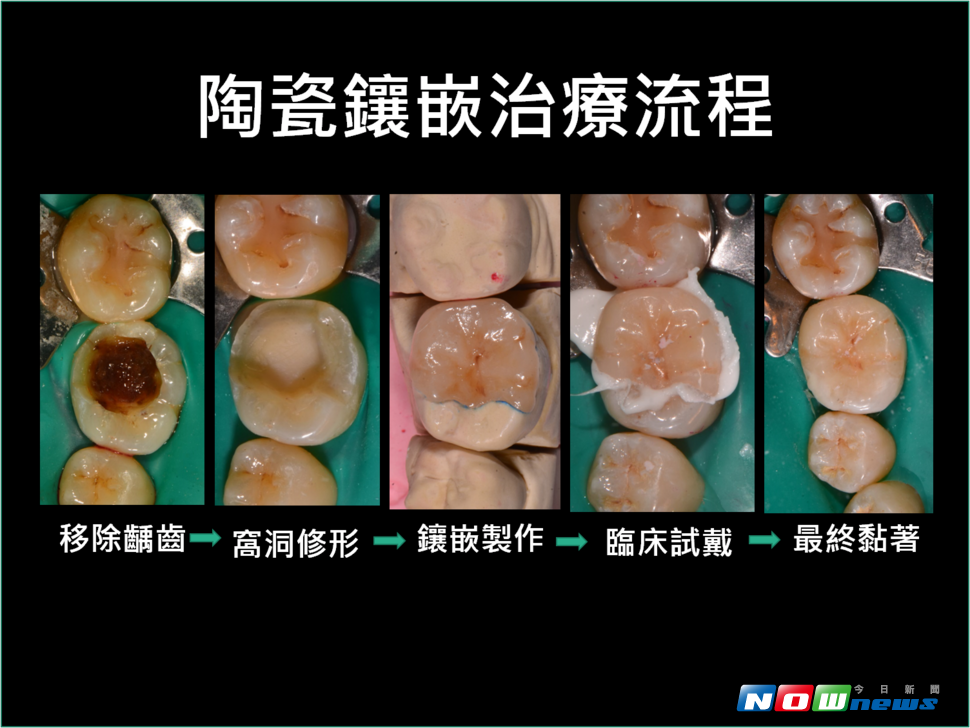 陶瓷鑲嵌治療流程（圖／記者洪佳伶翻攝 , 2017.07.07）