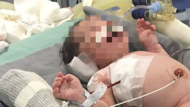 在媽媽子宮中遭流彈擊中奇蹟生還的巴西男嬰。（圖／翻攝自網路）