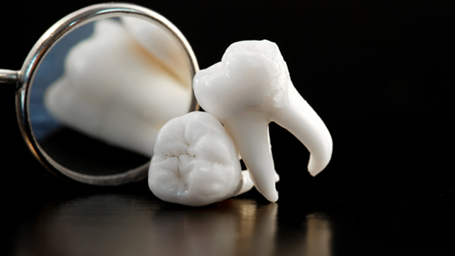 ▲患者須先釐清牙齒與牙周病間的關係，缺牙會導致鄰近部位的骨頭萎縮，以及其他原生牙因受力不均而位移崩壞。（圖／ingimage）
