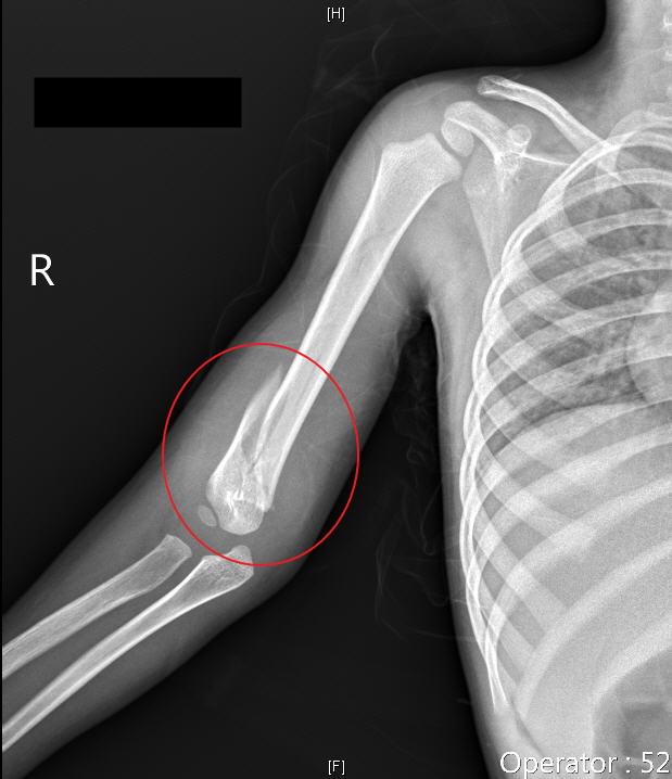 停止兒少虐待　社工警覺性高
