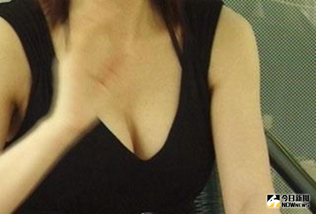 ▲一名女子接受自體脂肪隆乳，術後出現淋巴增生等後遺症，她指控醫師未盡說明義務，又在她乳房注射過量脂肪，怒而向診所及醫師提告求償。（示意圖／NOWnews資料照片）