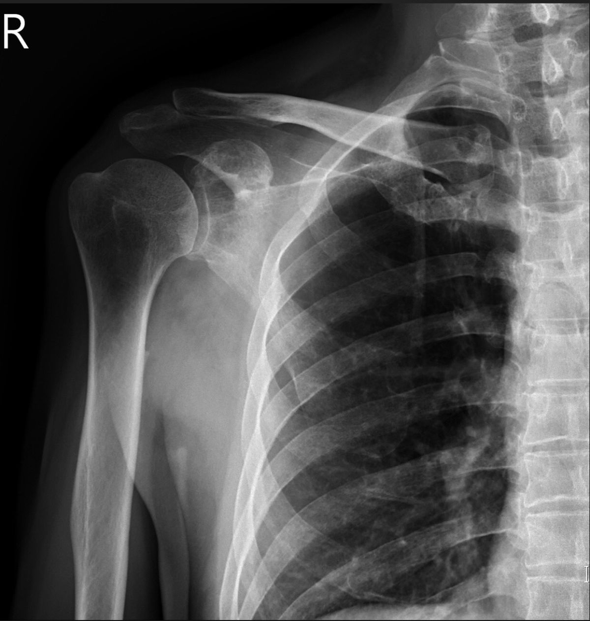 ▲肩膀疼痛勿輕忽，有人檢查發現是近3公分胸腺癌。（圖／記者黃文博翻攝，2018.01.29）